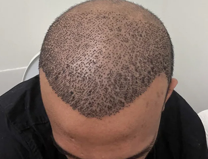 Robotic Hair Transplant